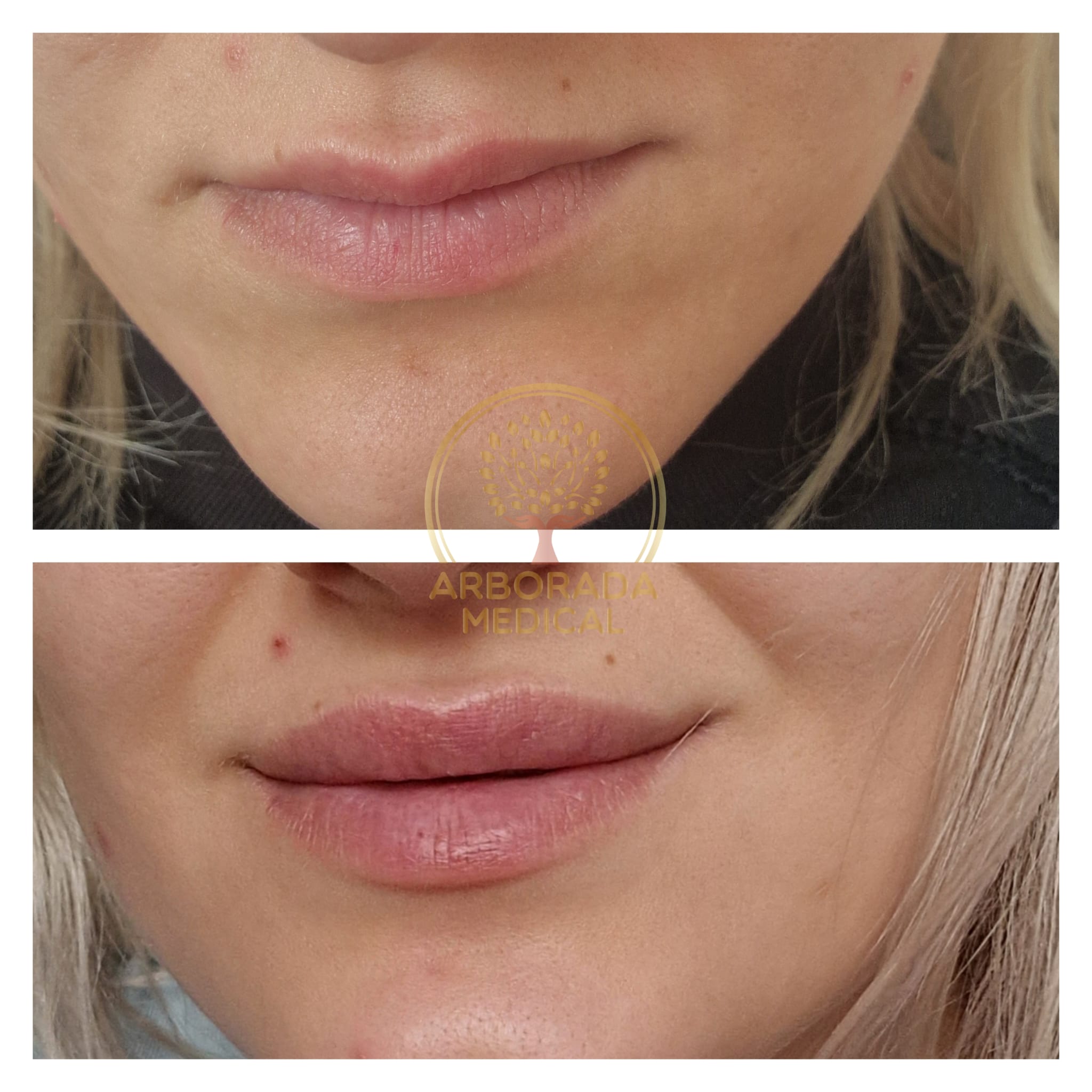 augmentare buze cu acid hyaluronic oradea hyaluron pen