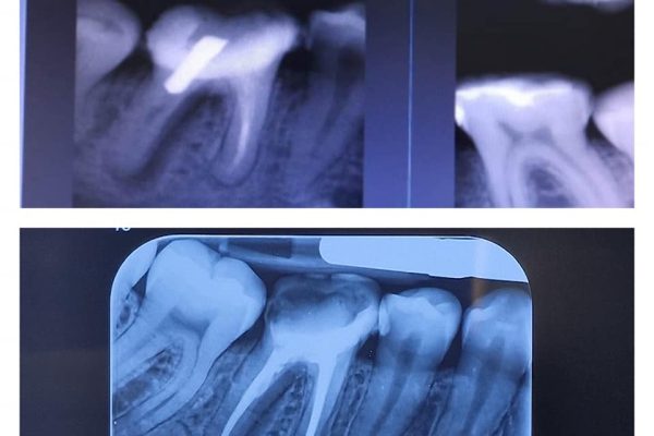 ENDODONTIE ORADEA